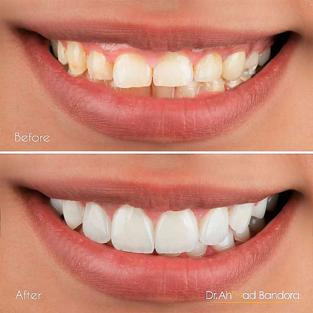 Natural veneers give you a charming smile.
