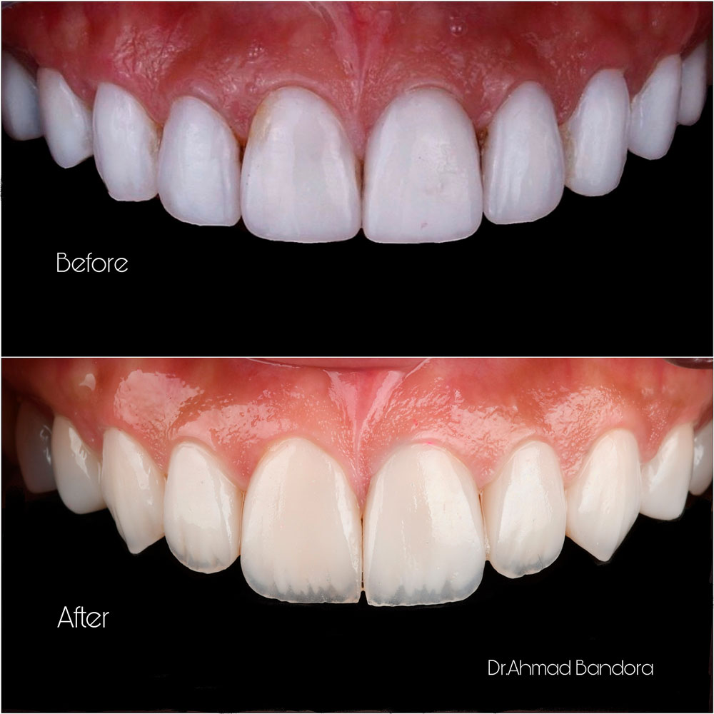 Using natural veneers instead of fake-looking ones gives you a stunning smile