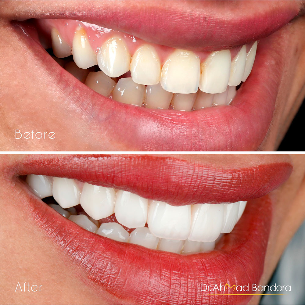 By using natural veneers instead of fake-looking ones, you can get a smile that goes better with your skin tone