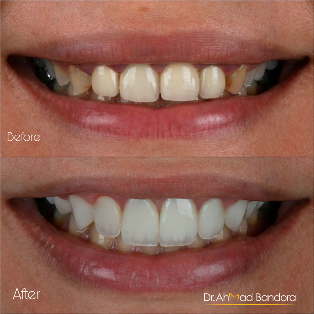 Get a charming smile with natural veneers