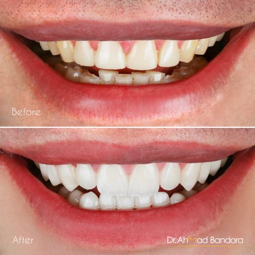 Dr.Ahmad Bandora, Before & After veneers