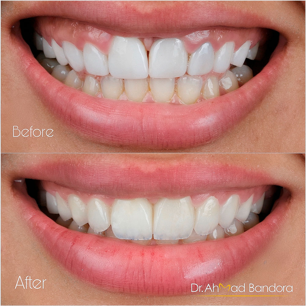 Natural veneers give you that unique smile you deserve